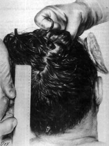 Kennedy autopsy photo showing wound at the back of the head.